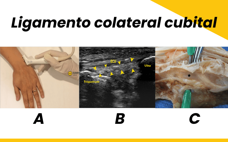 Ligamento Colateral Radial Y Ligamento Colateral Cubital - Ecografía Y ...